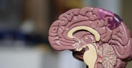 Nova teràpia per a l'esclerosi múltiple podria detenir o revertir els símptomes