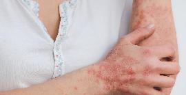 14 de setembre: Dia Mundial de la Dermatitis Atòpica