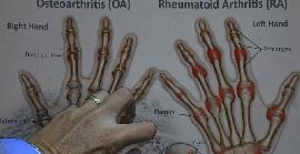 12 d'octubre: Dia Mundial de l'Artritis Reumatoide