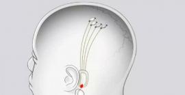 Milers de pacients esperen ser triats per Neuralink perquè els implanten un xip cerebral